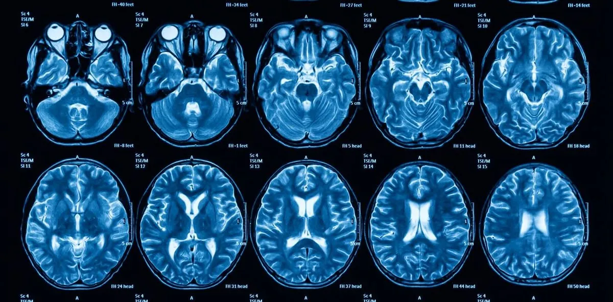 Neuroimagem do burnout executivo